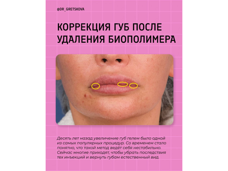 Часто после введенного ранее биополимера появляетс...