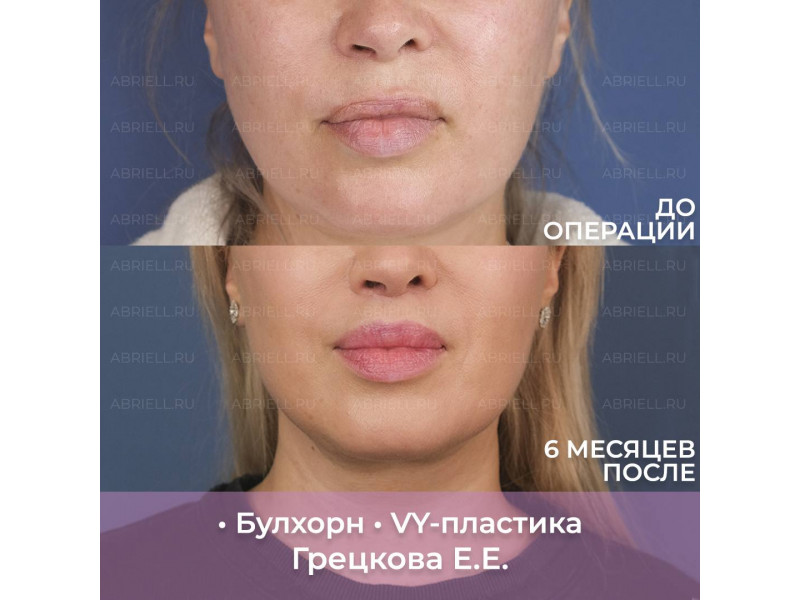 Мы с пациенткой прошли не самый лёгкий реабилитаци...