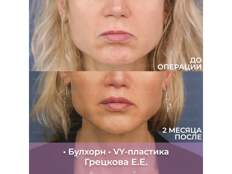 VY-пластика и булхорн позволяют в ряде случаев кар...