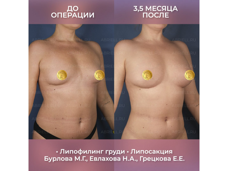 Смотрите БОЛЬШОЙ ролик - история нашей пациентки А...