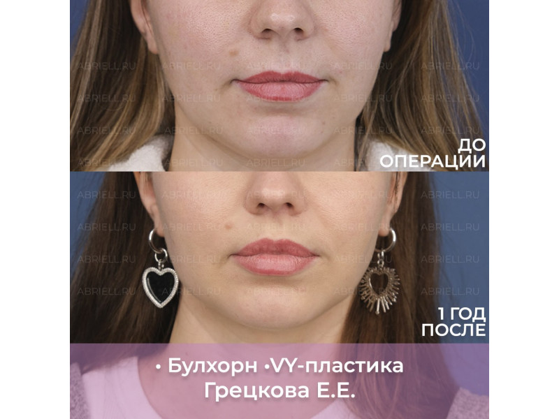 Совмещение булхорна и VY-пластики губ: можно ли ув...