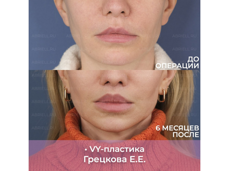 Булхорн + VY-пластика. Результат через 6 месяцев п...