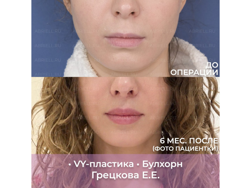 Булхорн + VY-пластика. 6 месяцев после хейлопласти...