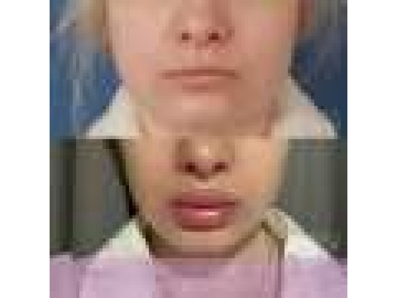 От чего зависит объём после V-Y пластики?